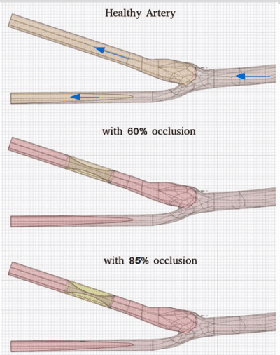 carotid artery bifurcation