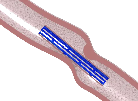 stent simulation